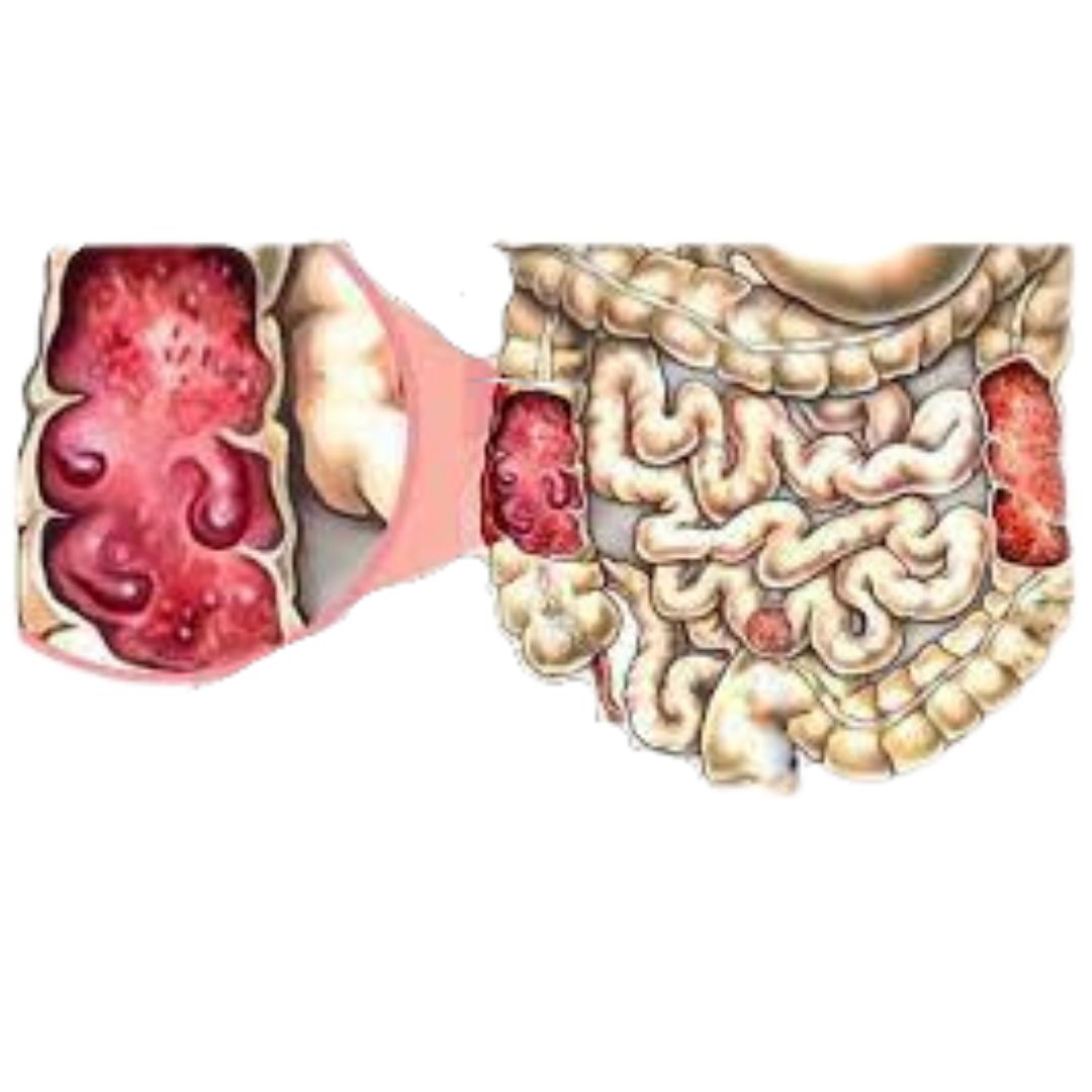 Intestinal TB