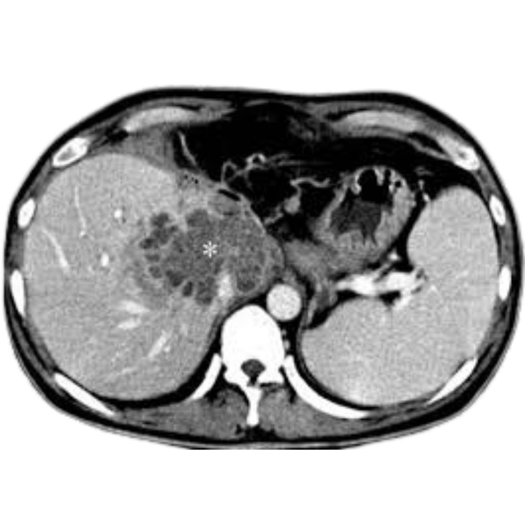 Liver TB