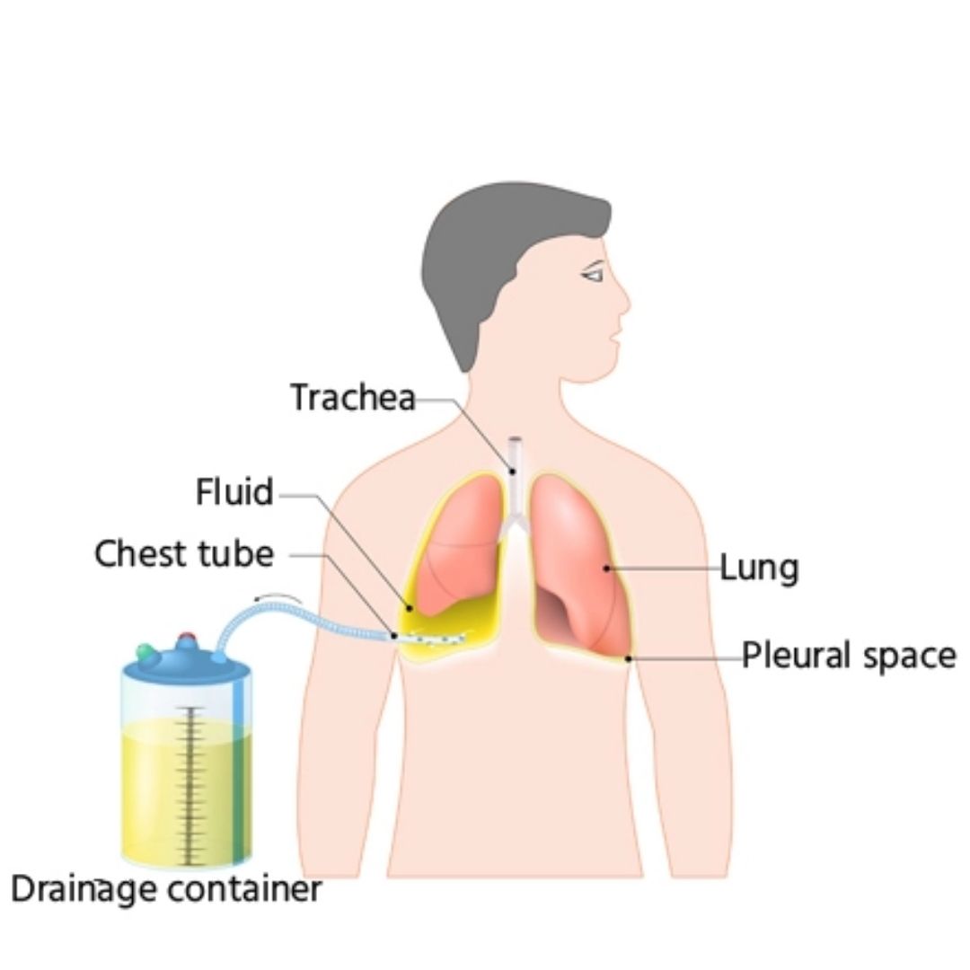 Pleural TB