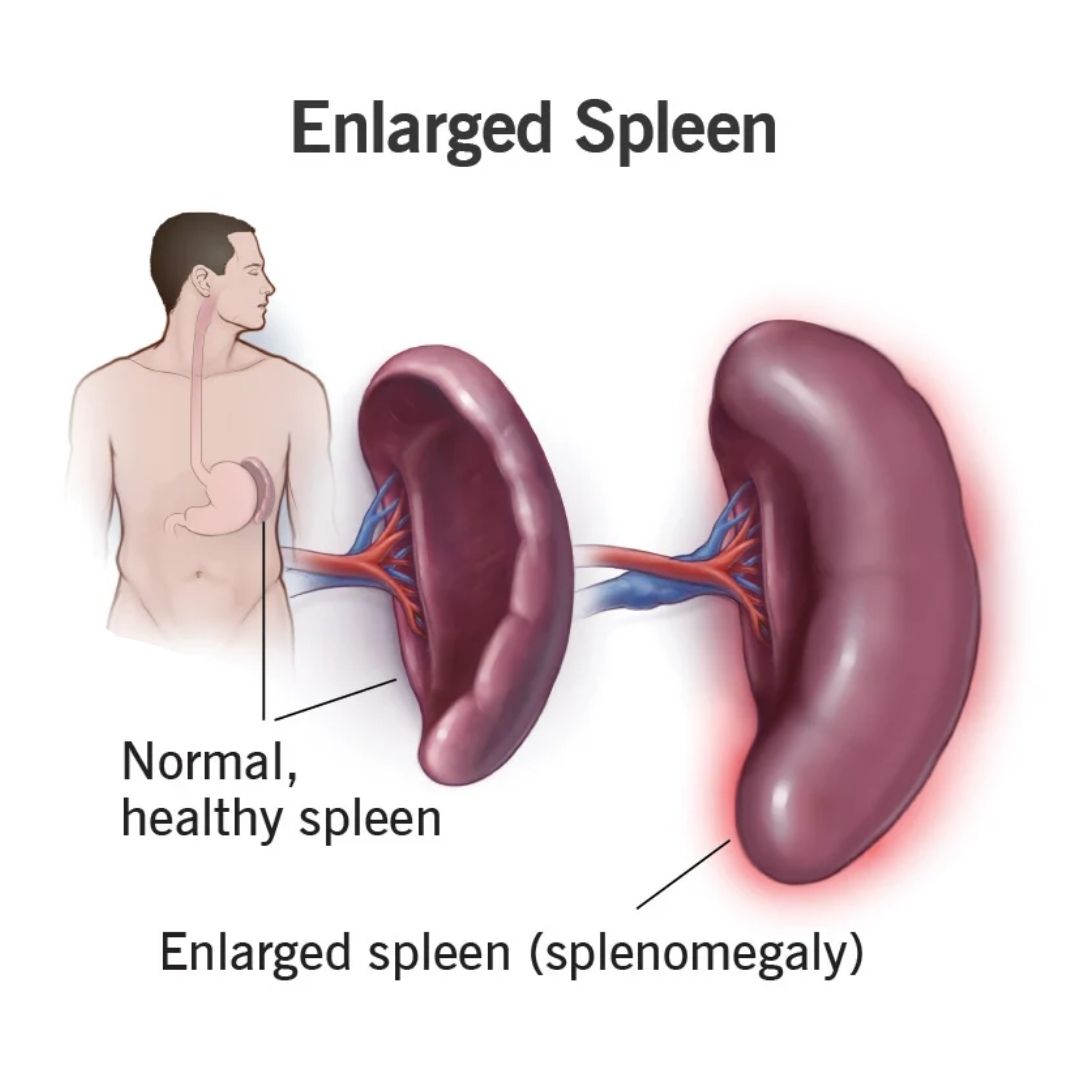 Spleen TB
