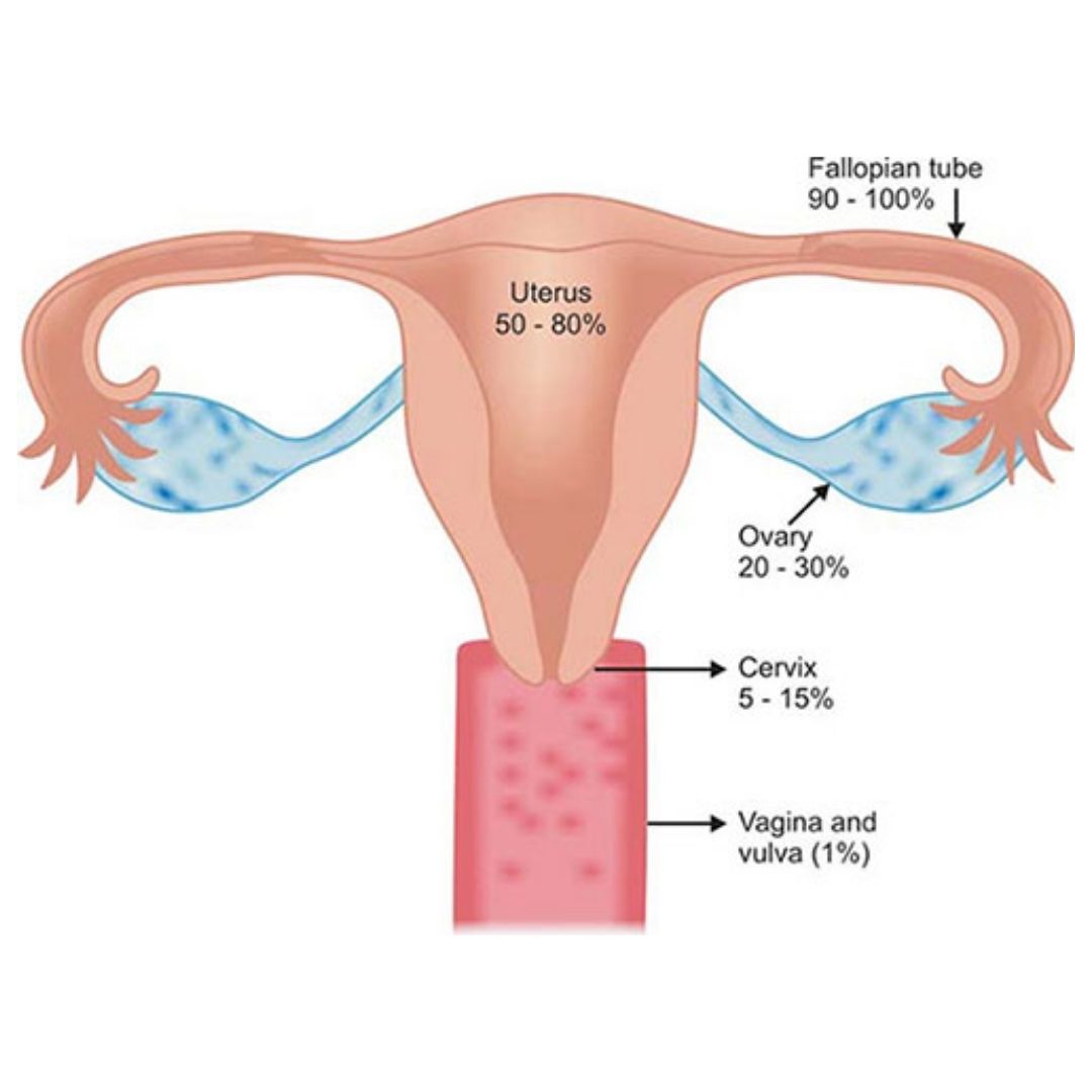 Uterine TB